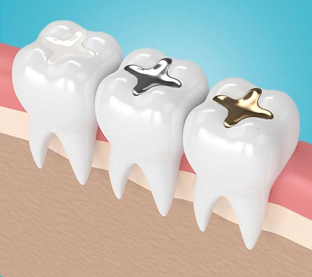 Norwood Composite Fillings