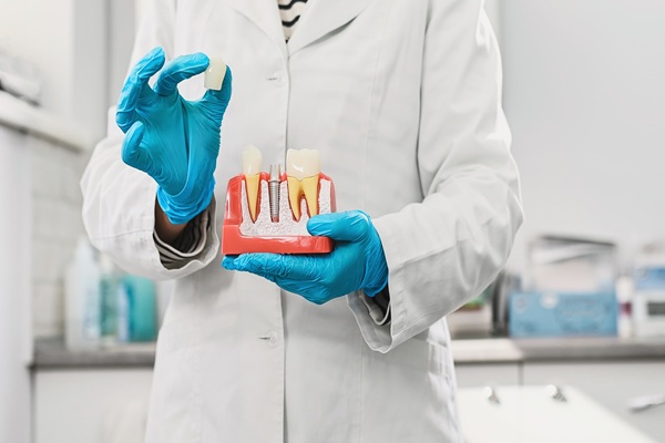 The Average Longevity Of Dental Crowns