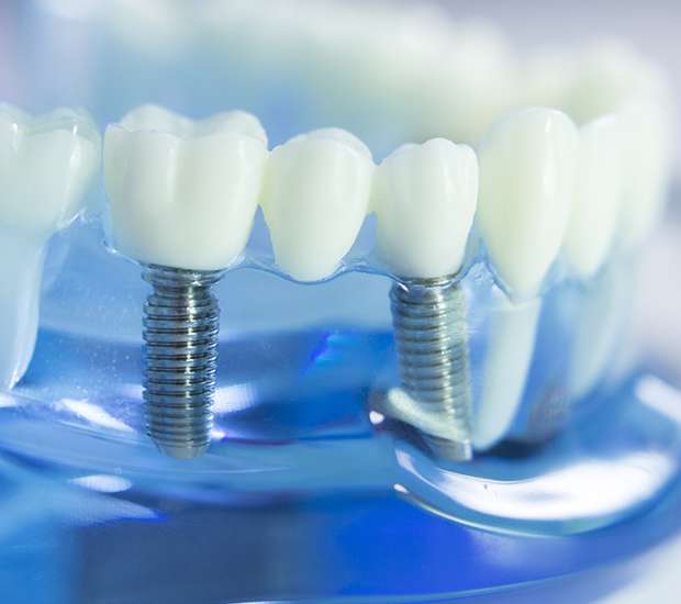 Norwood Dental Implants